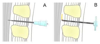 BD Yale Spinal-und Lumbalpunktionskanüle 22 G x 3 1/2"; 0,7 x 90 mm